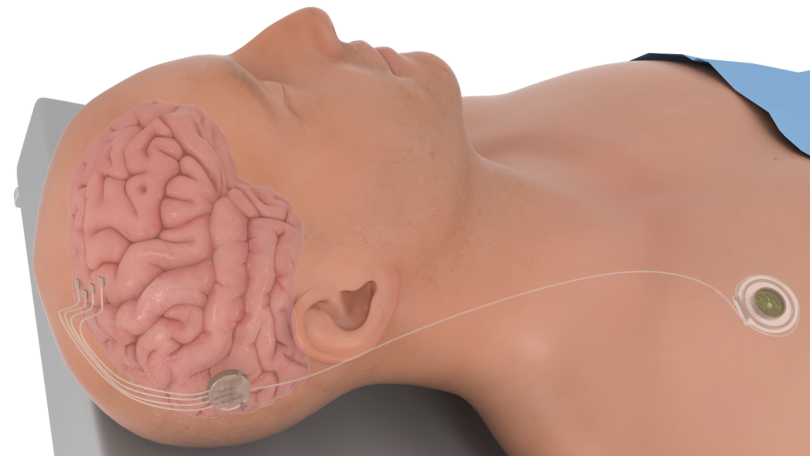 Microelectrode arrays are often surgically inserted on the surface of the brain in the sensorimotor cortex.