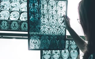AI system detects Alzheimer’s disease 6 years faster than clinical diagnosis