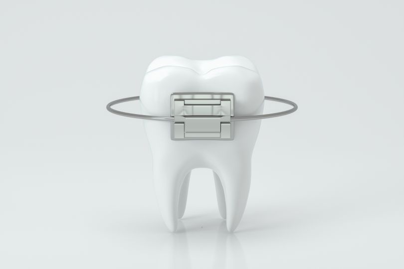 A single tooth is pictured wrapped in an orthodontic brace.