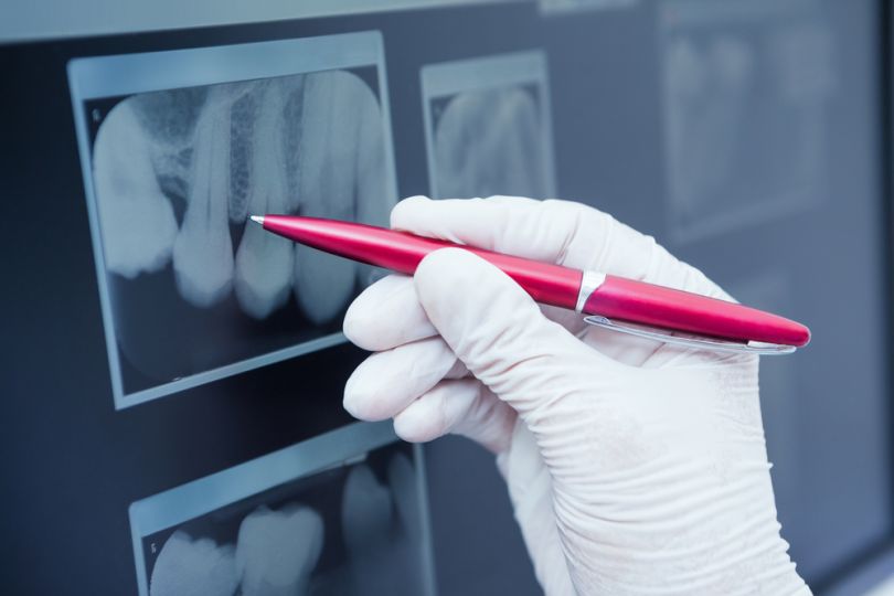 Dental X Ray